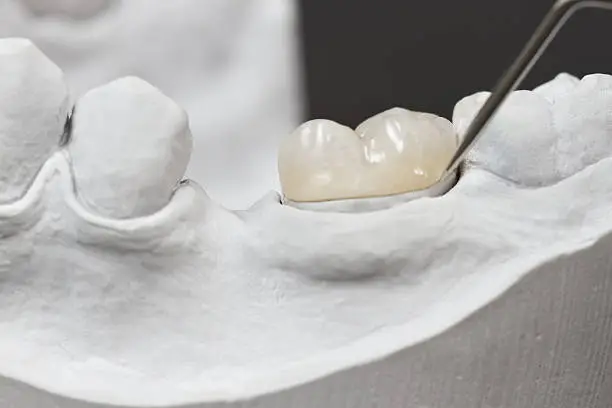 E-max Crowns